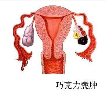 哪些情况可能是长了巧克力囊肿
