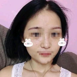 9600元做的激光祛斑手术,各位宝妈们瞧瞧值不值妈妈网轻聊千万女人的共同选择