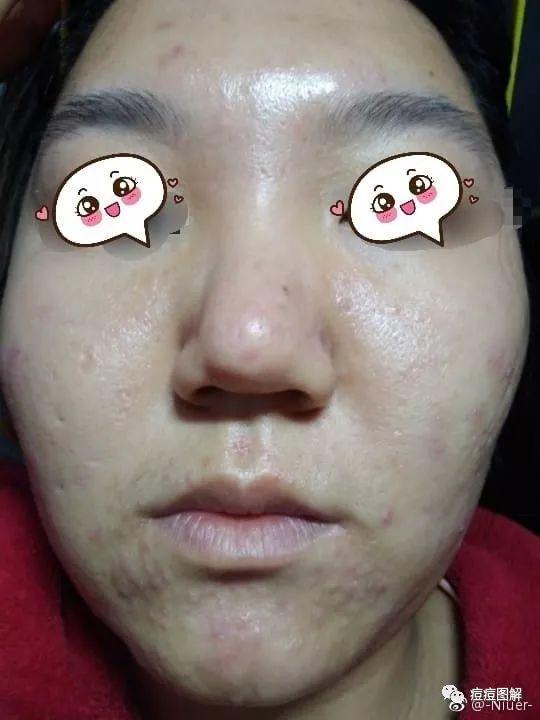 痘痘治疗方法7丘疹型痘痘凹陷癫痕红色痘印