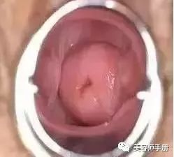 女性可怕的宫颈病变炎症糜烂囊肿息肉肥大防大于治呀