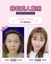 全脸脂肪填充广州韩妃自体脂肪面部填充精雕气质童颜少女脸一次成型无需二填悦美整形