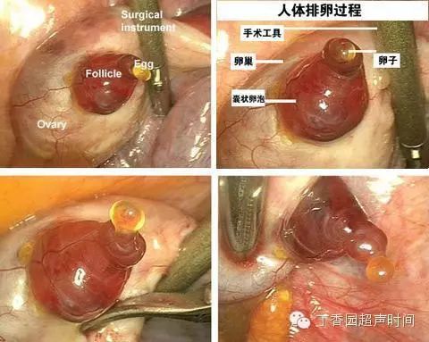 卵泡长得好不好来看看卵泡监测的那些事