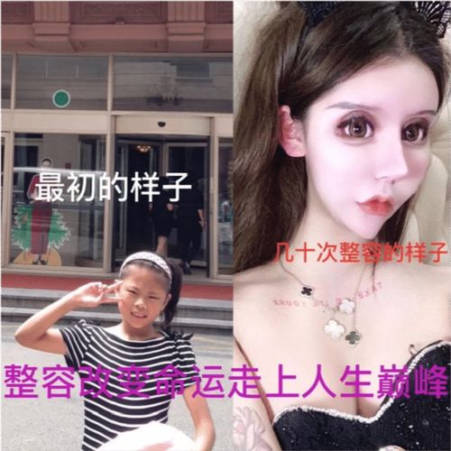 15岁娜娜花费400万整容,被网友吐槽像60岁,她后来如何