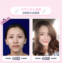 全脸脂肪填充广州韩妃自体脂肪面部填充精雕气质童颜少女脸一次成型无需二填悦美整形