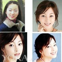 韩国女星整容成瘾一整年轻20岁