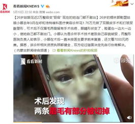 26岁姑娘花近2万整容变毁容现在连门都不敢出