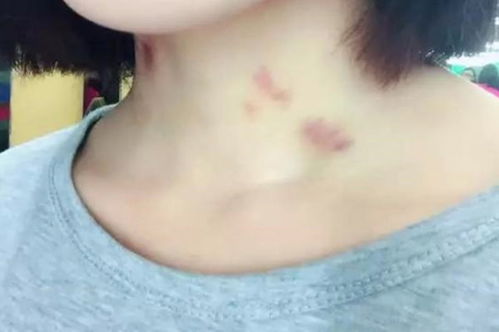 热恋的男女注意了,不要随意在脖子上种草莓,对健康是有影响