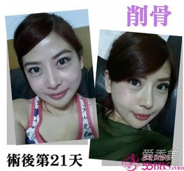 削骨美女26岁台湾女子削骨整形全过程