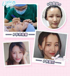 全脸脂肪填充广州韩妃自体脂肪面部填充精雕气质童颜少女脸一次成型无需二填悦美整形