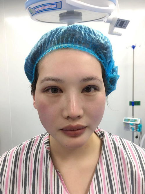 女子双眼皮手术失败一度抑郁,两年后走上修复之路,重获新生