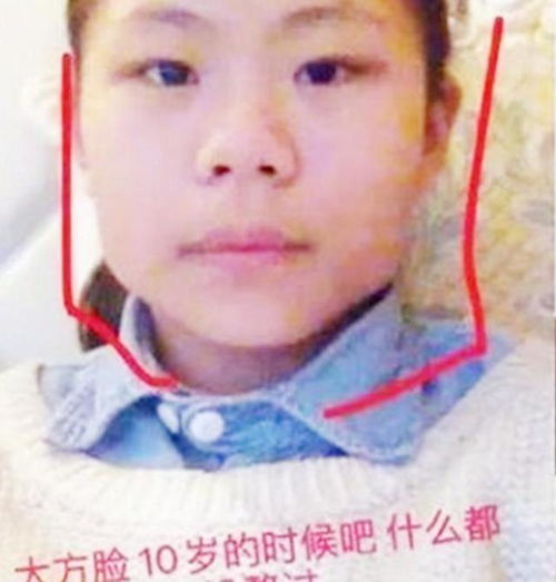 16岁女孩整容上瘾,光是在脸上3年整了近百次,老师已无童真