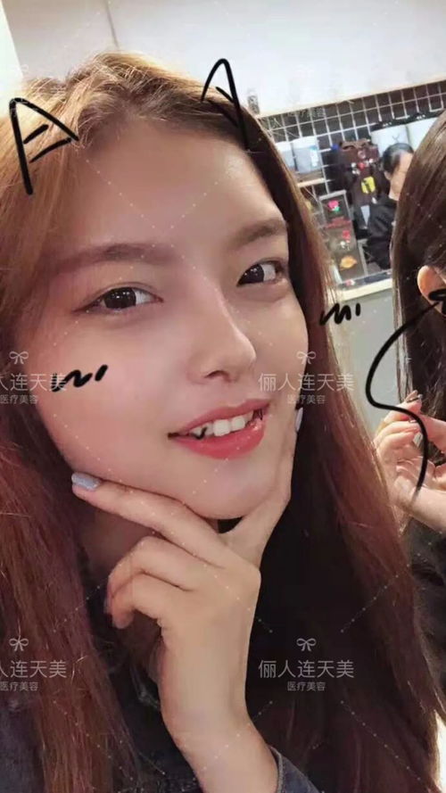 真人案例丨想当侧颜美女,怎能没有小俏鼻