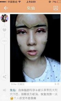 郑州15岁女孩整成蛇精脸自曝整容前后过程照