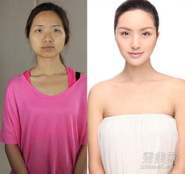 国内整容案例20位女性整容前后图