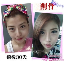 削骨美女26岁台湾女子削骨整形全过程