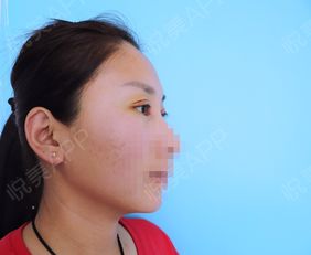 今天是拆线日儿子生病了,要带他去医院,所以我早早...开眼角悦美整形