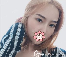 土味少女变形记成都铜雀台刘祎切开双眼皮开眼角术真人案例