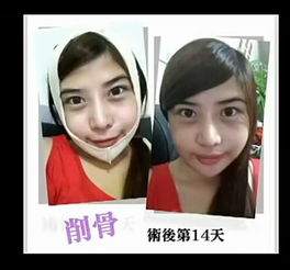 触目惊心台湾26岁女子爆削骨整容全过程