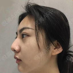 我的五官一直很大气,但是不满意的就是鼻子了,鼻头像...垫鼻尖悦美整形